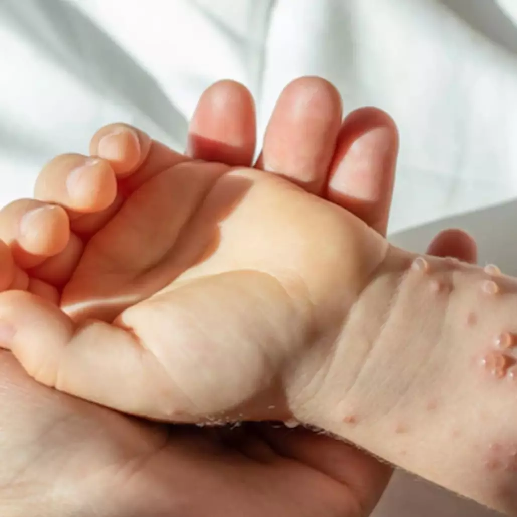 11 Penyebab herpes pada anak, kenali gejala dan ketahui cara pencegahannya