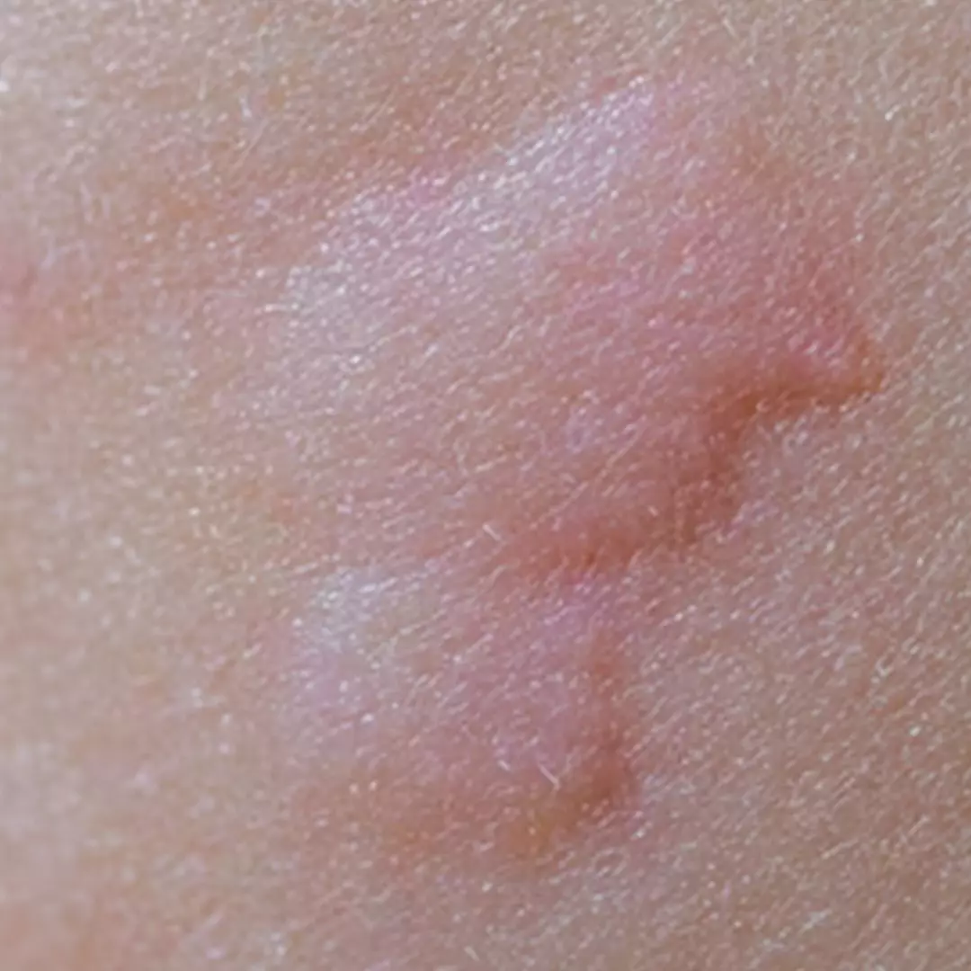 Dijamin ampuh, begini 7 cara mengatasi biduran menggunakan bahan alami