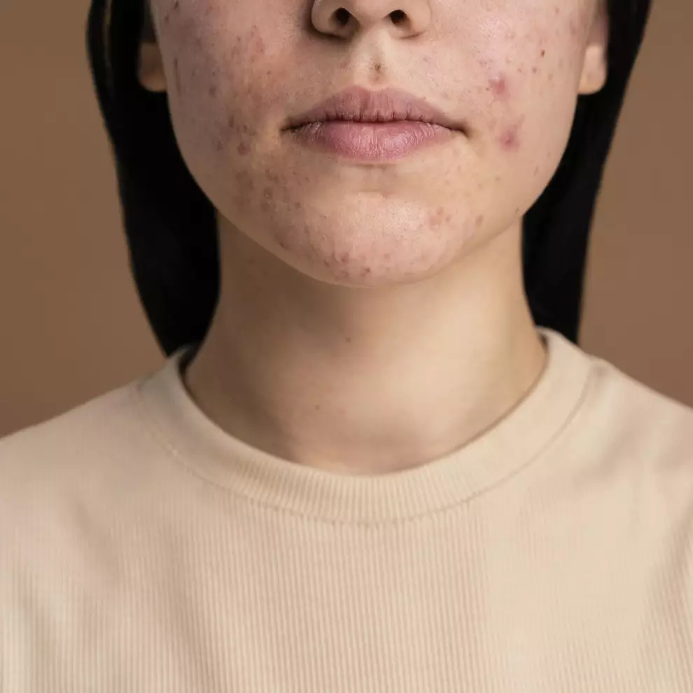 7 Rekomendasi bedak untuk kulit berjerawat harga mulai dari Rp 15 ribu