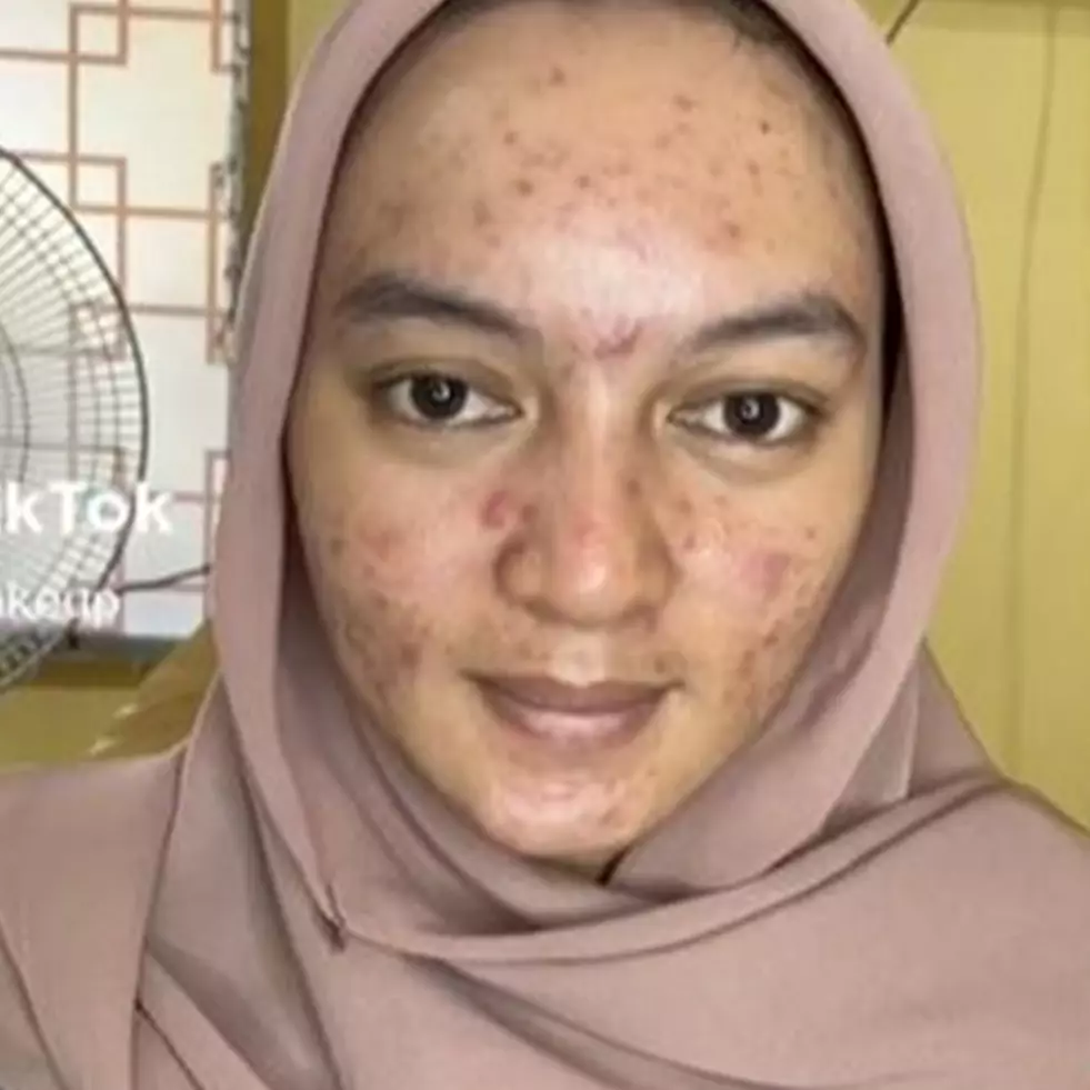 Wajah wanita penuh jerawat dirias MUA hasilnya jadi mirip Citra Kirana, bikin pangling
