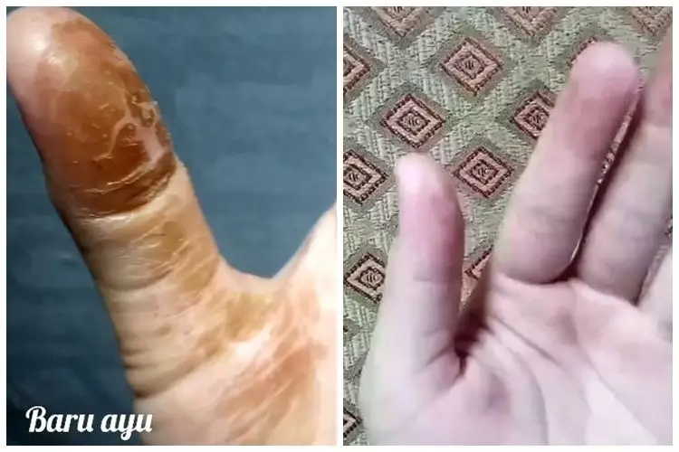 Bukan pakai sabun, ini cara cepat menghilangkan getah labu siam yang menempel di tangan