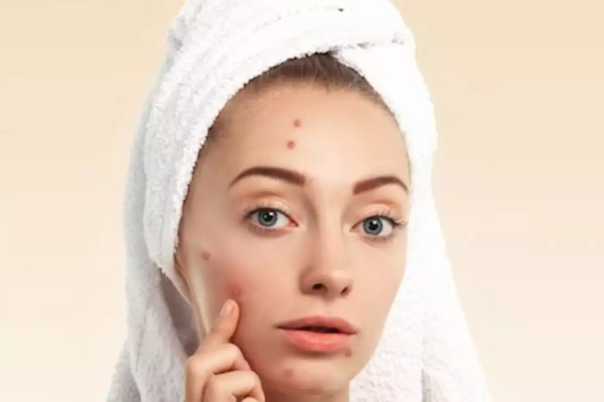 Bukan pakai color corrector, begini trik tutupi bekas jerawat dan flek dengan 2 produk makeup