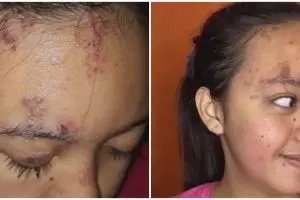 Wajah pengantin kena cacar api jelang nikah ini dirias MUA pakai Paes Solo, hasilnya tuai pujian