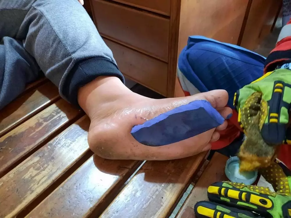 kaki bocah ini harus ditangani Damkar karena nempel di sandal jepit Berbagai sumber