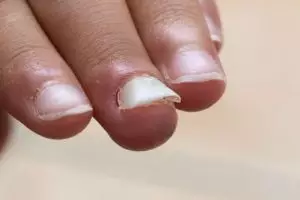 Jangan dilepas paksa, ini 7 cara mengatasi kuku rusak akibat nail art