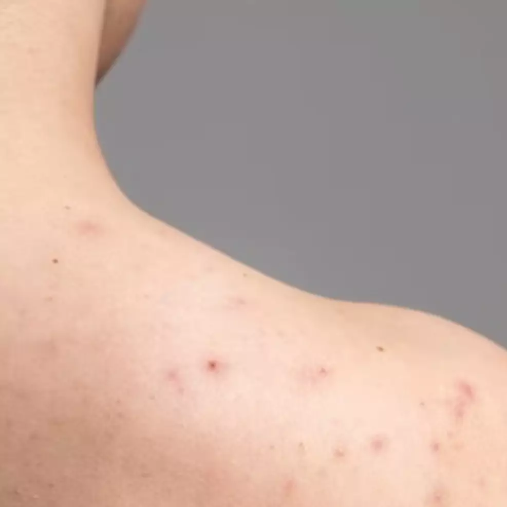 9 Rekomendasi sabun untuk mengatasi jerawat punggung mulai Rp 10 ribu, jadikan kulit bersih dan mulus