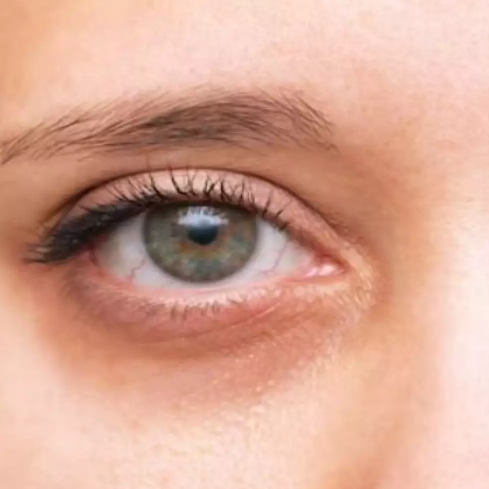 Cuma butuh 2 bahan dapur, ini trik atasi mata lelah agar bebas dari lingkaran hitam