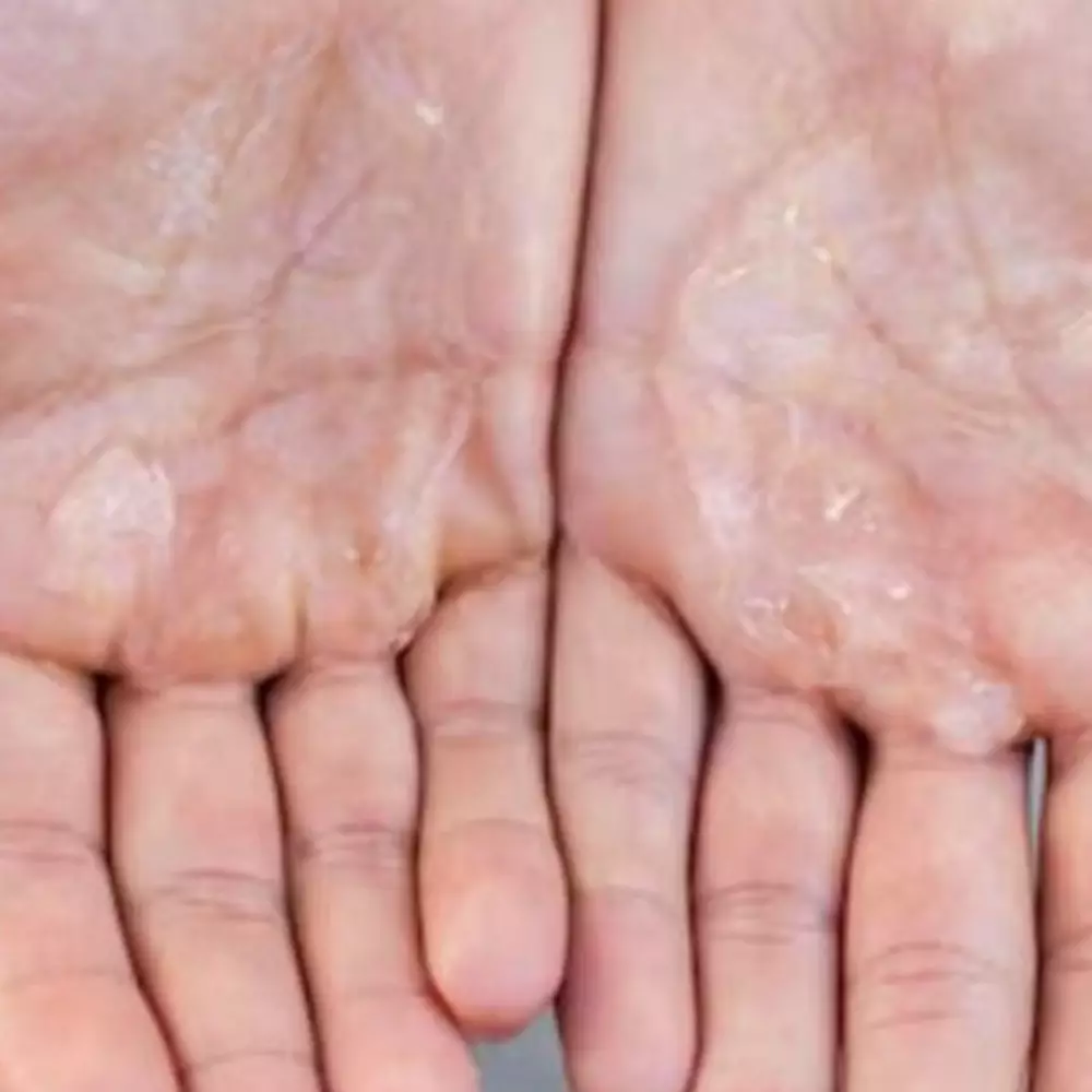 Cegah kulit bersisik, ini 10 cara mengatasi kulit tangan kering yang wajib kamu tahu