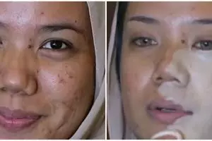 Wajah breakout menjelang pernikahan, wanita yang berjerawat ini dirias MUA hasilnya manglingi