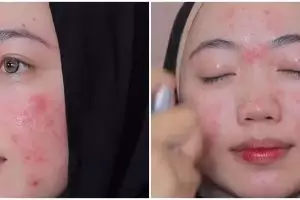 Wajah wanita breakout jelang pernikahan dirias MUA jadi pengantin modern, hasilnya cantik maksimal