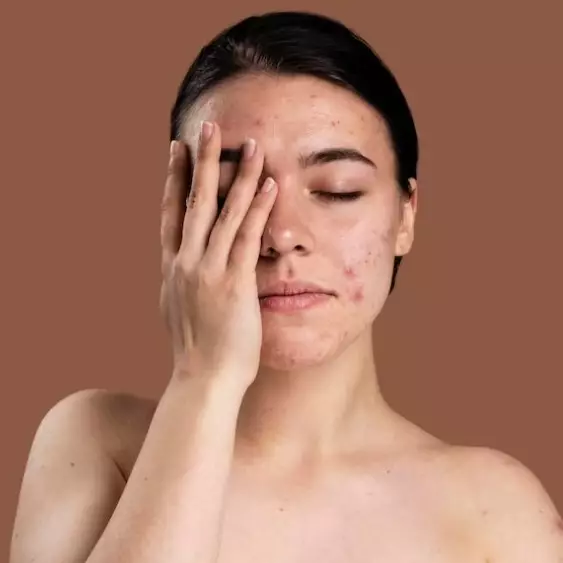 Cara atasi beruntusan dan jerawat pakai masker dari 3 bahan dapur ini bikin wajah halus dan lembut