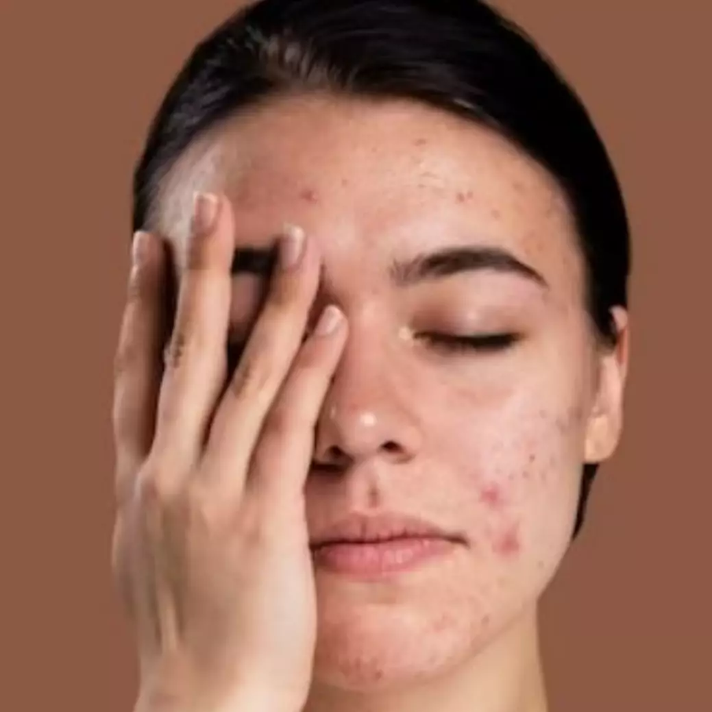 Hanya pakai 3 bahan dapur, ini trik atasi dan cegah tumbuhnya jerawat agar wajah mulus kembali