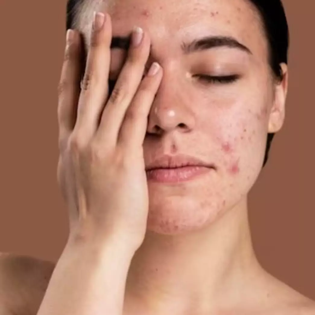 9 Cara merawat kulit berjerawat agar cepat kempes, hindari penggunaan scrub