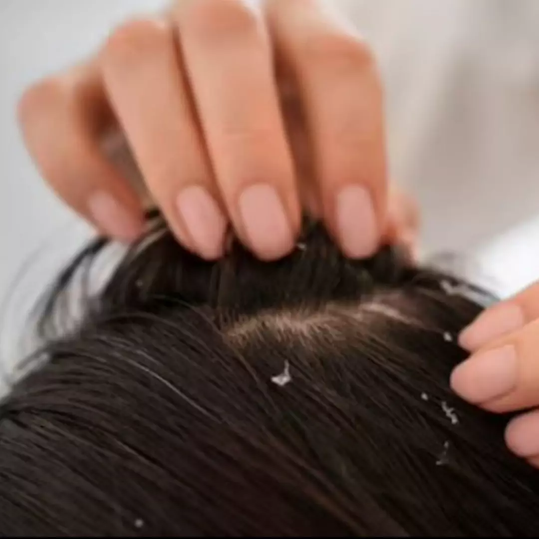 Trik membersihkan ketombe kering ini hanya butuh 2 jenis minyak alami, bantu atasi gatal di kepala