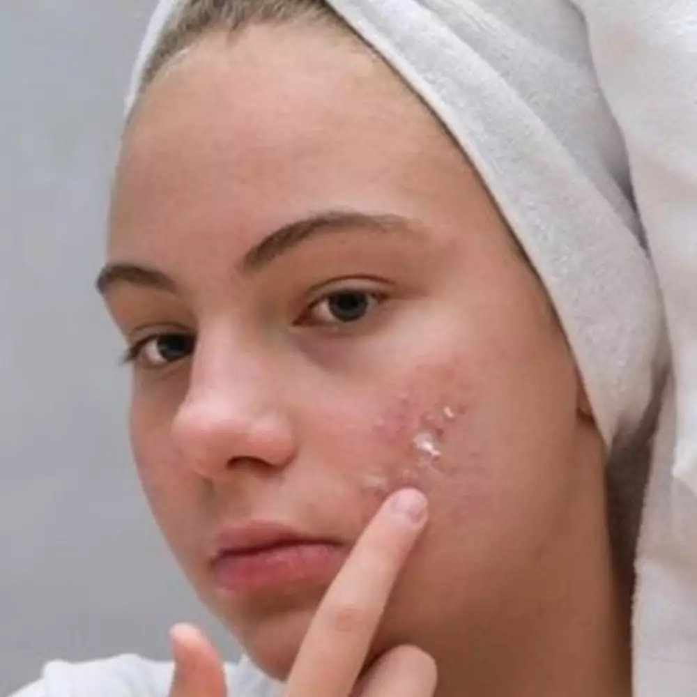 Bikin wajah mulus, ini 9 rekomendasi obat jerawat untuk ibu hamil harga mulai Rp 40 ribuan