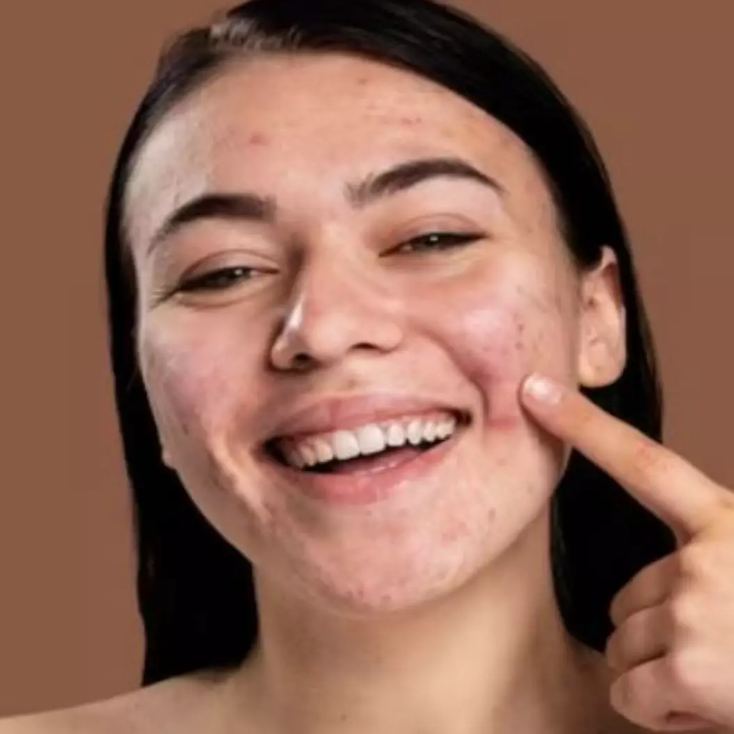 Cuma pakai 2 bahan dapur, begini cara mengatasi jerawat membandel agar wajah kembali mulus