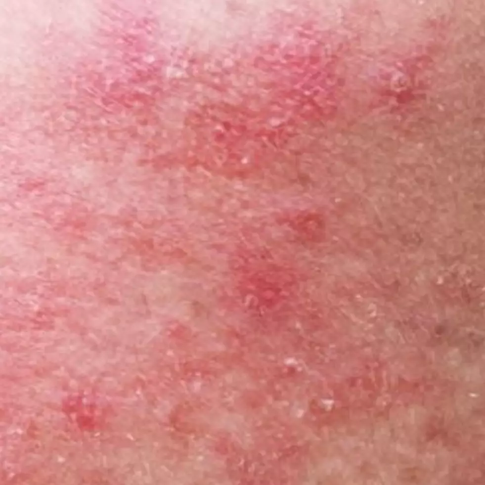 Trik atasi wajah iritasi hanya pakai 2 bahan alami, bikin glowing dan antikering