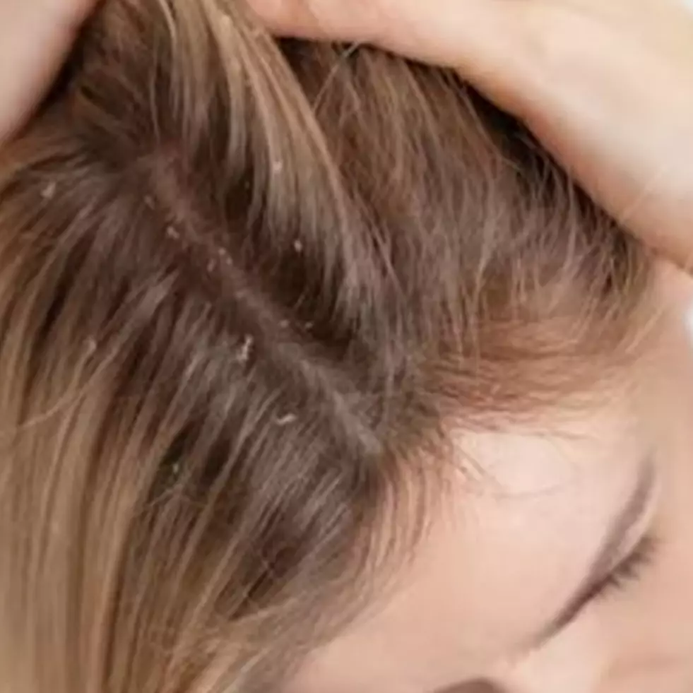 Bantu atasi ketombe dan redakan gatal, begini cara membuat sunflower oil sendiri di rumah