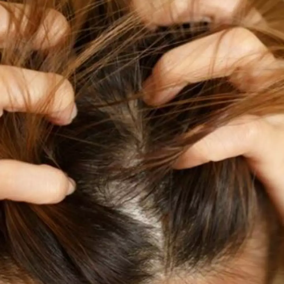 Cara atasi psoriasis pada kulit kepala ini hanya pakai 3 bahan alami, hilangkan gatal dan cegah rontok