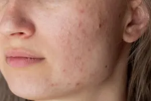 Cuma pakai 3 bahan dapur, begini cara menghilangkan bekas luka jerawat agar wajah kembali mulus