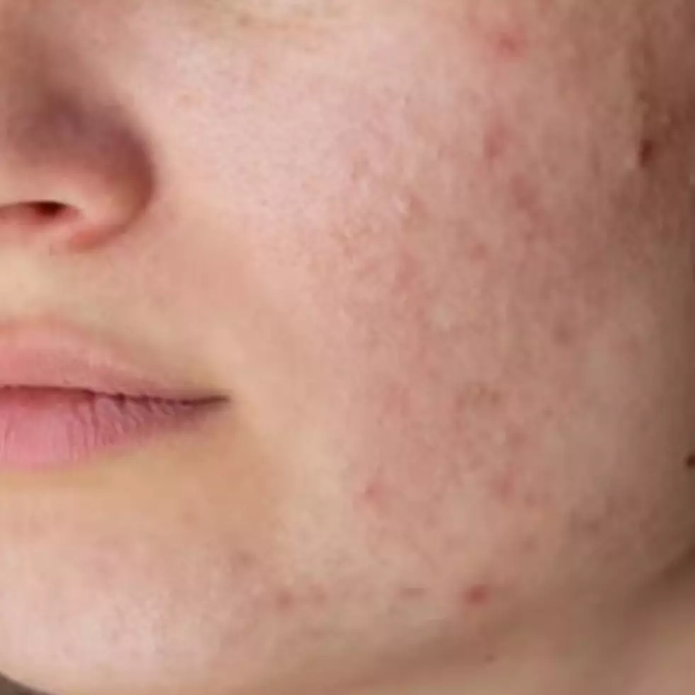 Cuma pakai 3 bahan dapur, begini cara menghilangkan bekas luka jerawat agar wajah kembali mulus