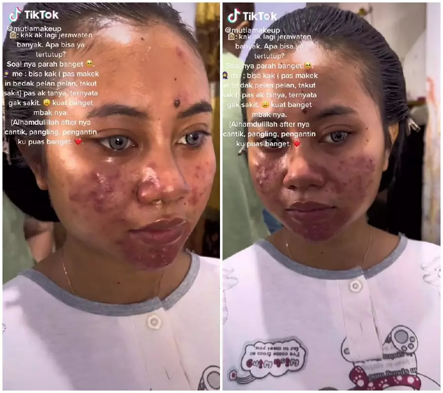 rias pengantin wajah berjerawat © TikTok/@mutiamakeup rias pengantin wajah berjerawat © TikTok/@mutiamakeup