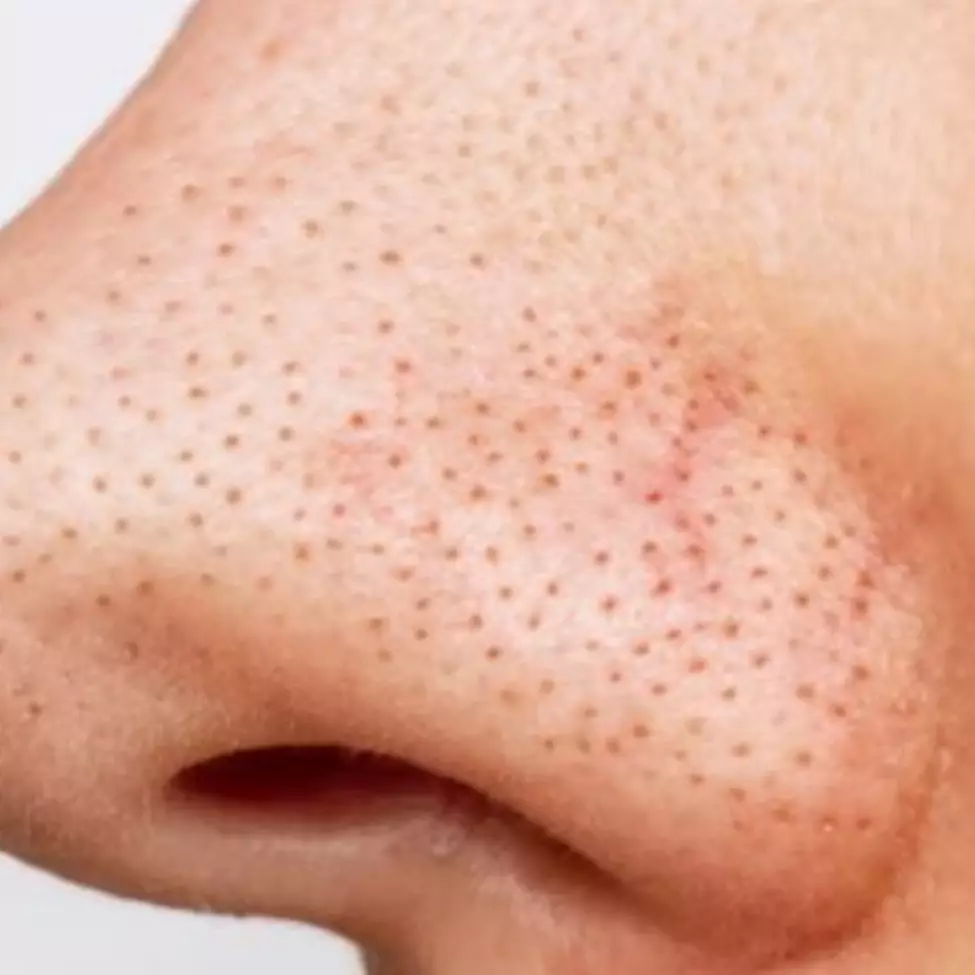 Wajah auto mulus, begini trik hilangkan komedo hitam membandel hanya pakai 2 bahan dapur