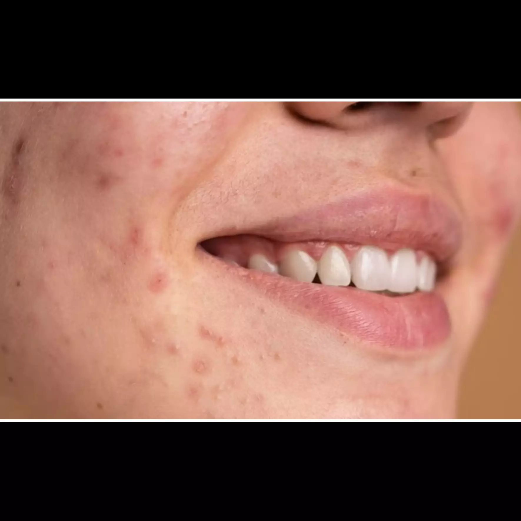 Cerahkan noda gelap bekas jerawat, ini trik bikin masker pencerah pakai 4 bahan dapur