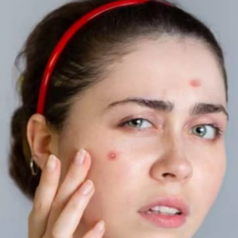 Trik mengempiskan jerawat membandel cuma pakai 2 bahan alami, bikin wajah lembap dan mulus