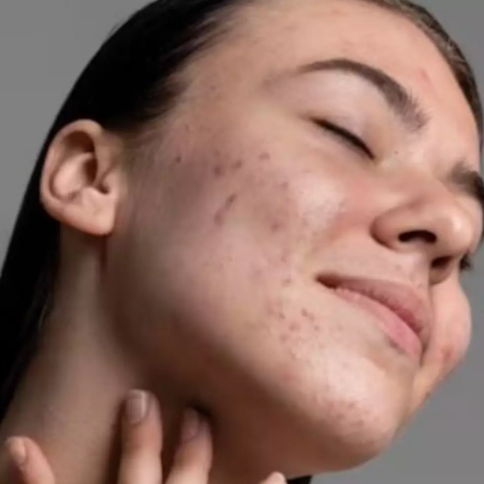 Auto mulus dan lembap, ini cara menghilangkan jerawat pakai overnight mask dari 3 bahan alami