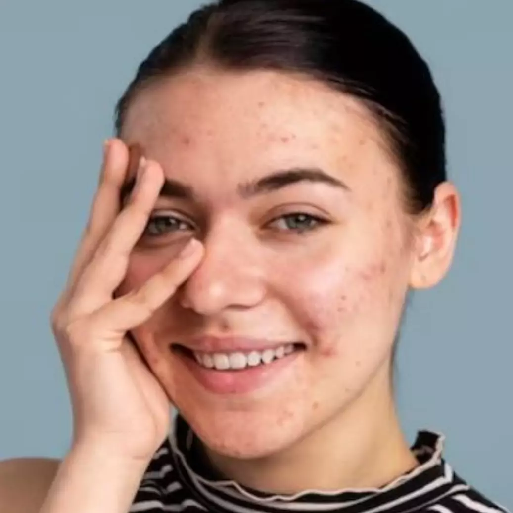 Hanya butuh 1 jenis buah, begini trik atasi wajah breakout agar kembali mulus dan bebas jerawat