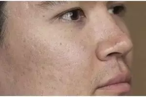 Trik hilangkan flek hitam hanya pakai 1 jenis lalapan ini bikin wajah auto glowing