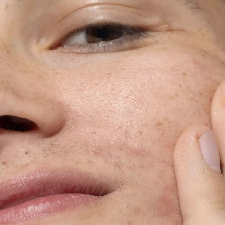 Trik atasi jerawat meradang di wajah pakai peel off mask dari 1 bahan minuman, bikin mulus tanpa bekas