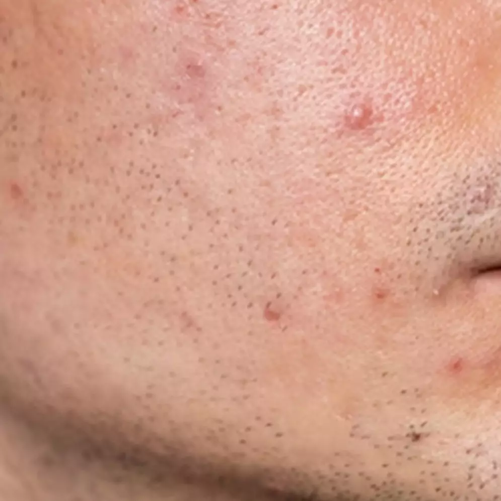 Nggak perlu beli, begini cara membuat acne spot untuk atasi bekas jerawat hanya pakai 1 bahan minuman