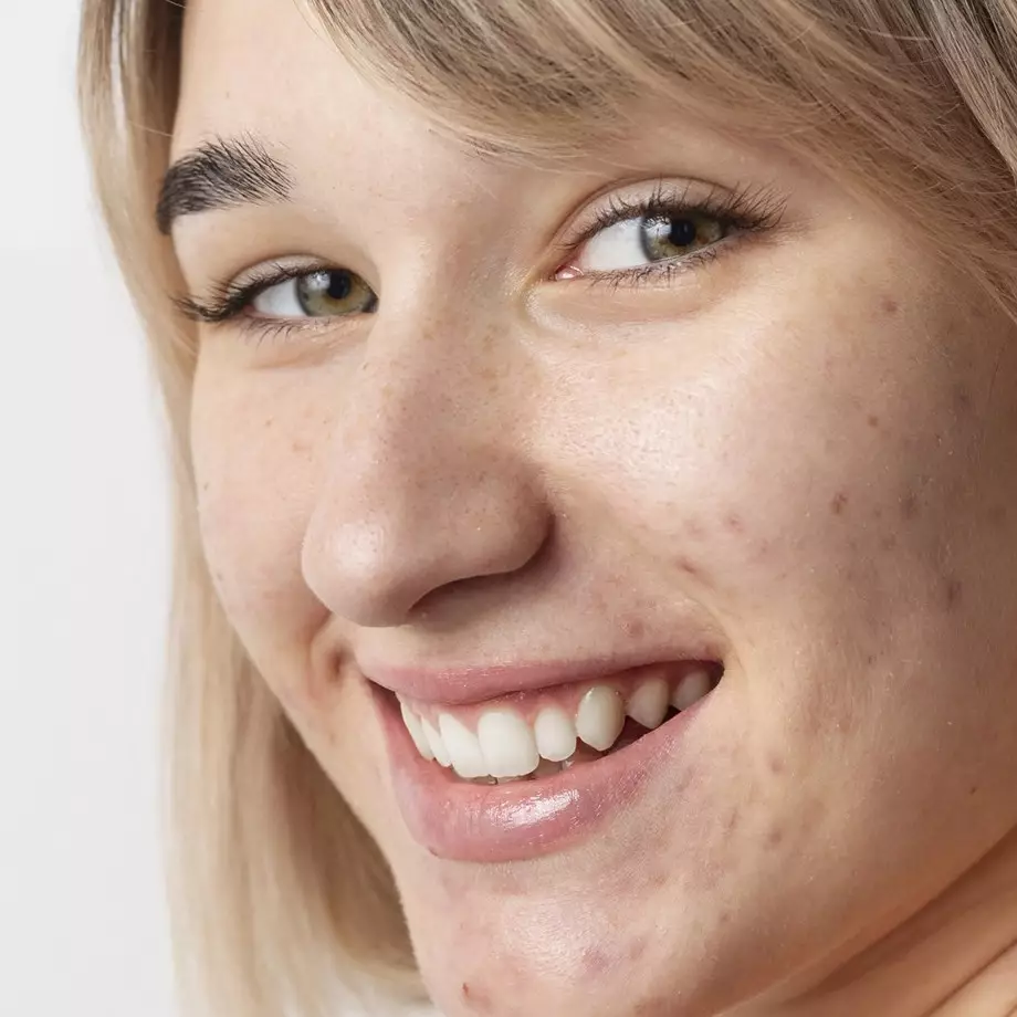 Cuma pakai 1 kulit buah, begini cara atasi jerawat membandel agar hilang dan tak membekas