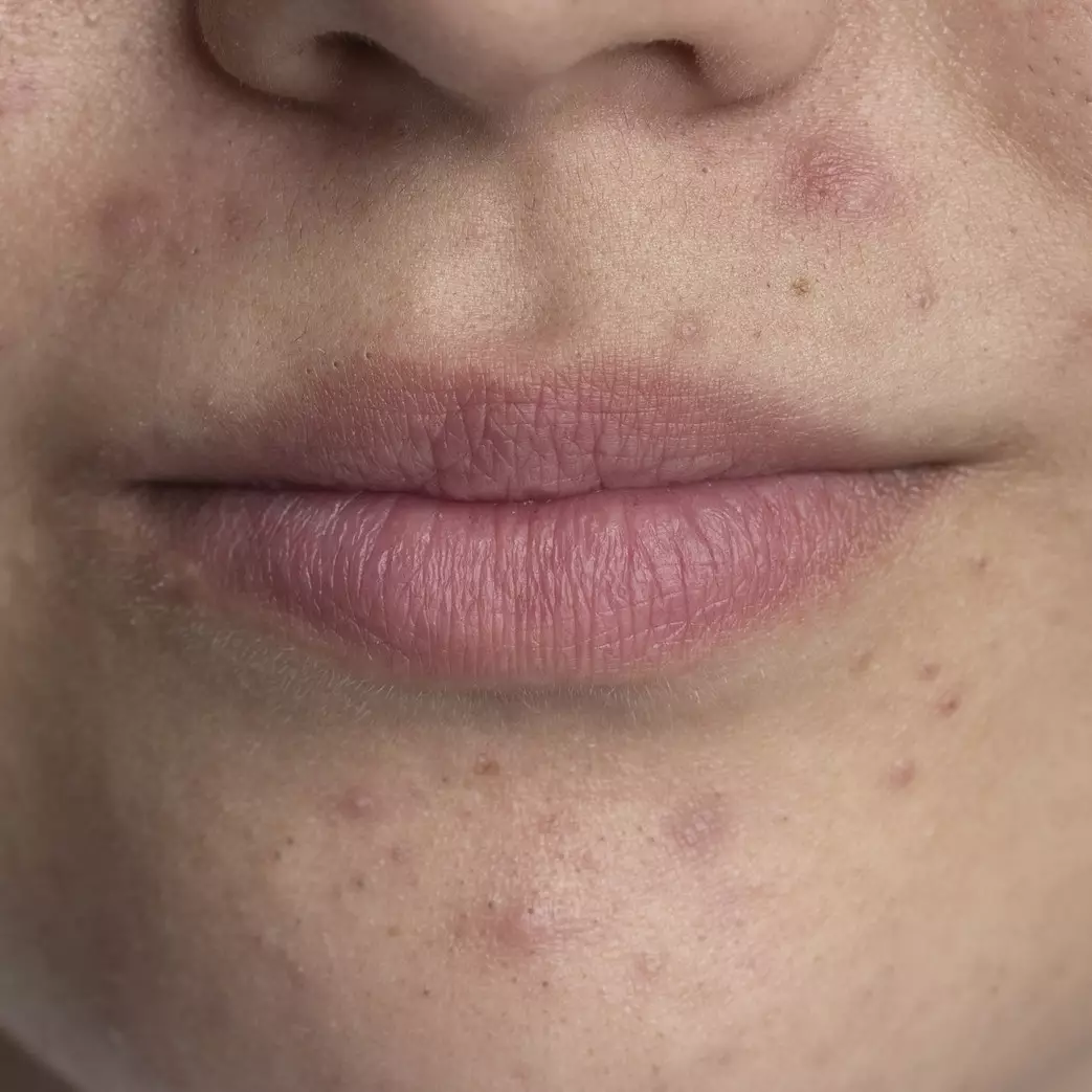 Tanpa chemical peeling, ini trik atasi flek hitam akibat jerawat hanya pakai toner dari 1 jenis bunga