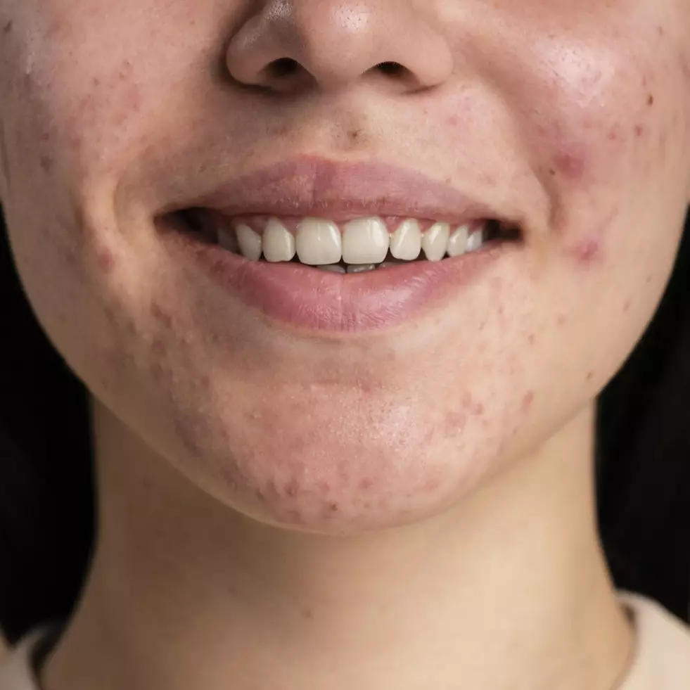 Wajah jadi bersih dan cerah, begini cara hilangkan jerawat meradang hanya pakai 1 jenis daun