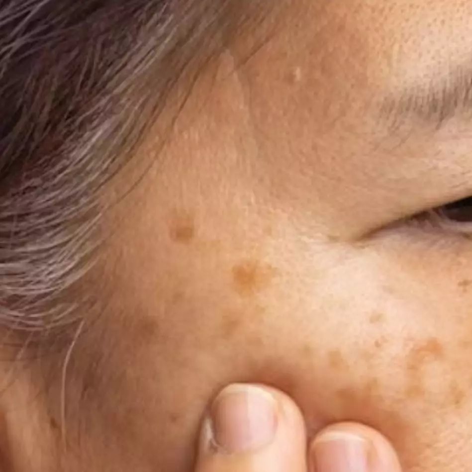 Cara menghilangkan flek hitam akibat hiperpigmentasi pakai 1 jenis buah, wajah mulus kembali