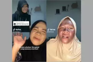 Curhat wanita pakai krim kandungan merkuri 3 tahun, alih-alih putih mulus wajahnya malah jadi gosong
