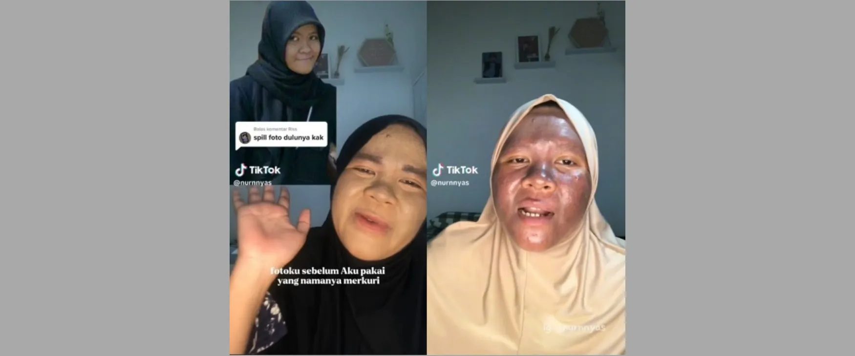 Curhat wanita pakai krim kandungan merkuri 3 tahun, alih-alih putih mulus wajahnya malah jadi gosong