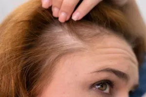 Cara menebalkan rambut tipis di sekitar dahi ini cuma pakai 2 jenis minyak, bikin lebat dan antibotak