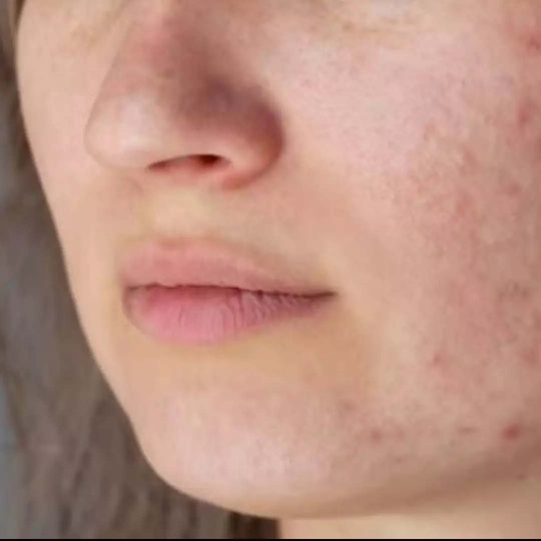 Nggak perlu laser wajah, ini cara menghilangkan luka bekas jerawat hanya dengan 1 jenis tepung