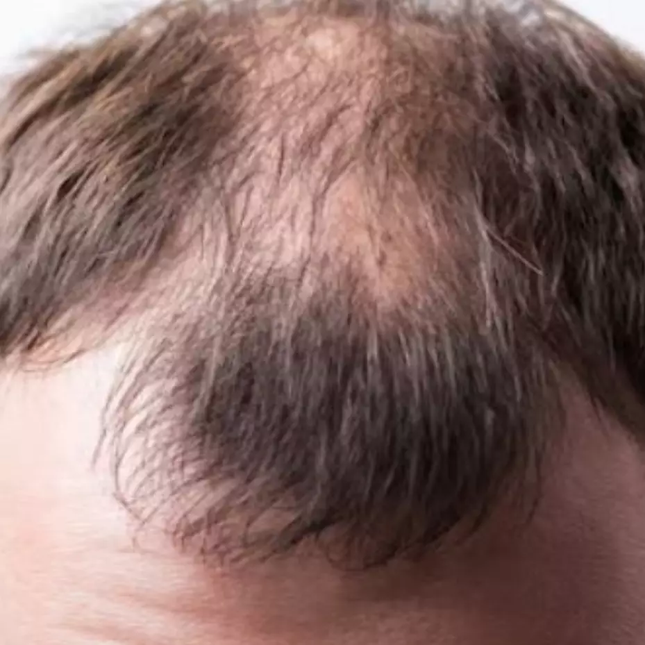 Antikering dan bebas botak, ini trik menumbuhkan rambut pria pakai masker dari 2 jenis minyak