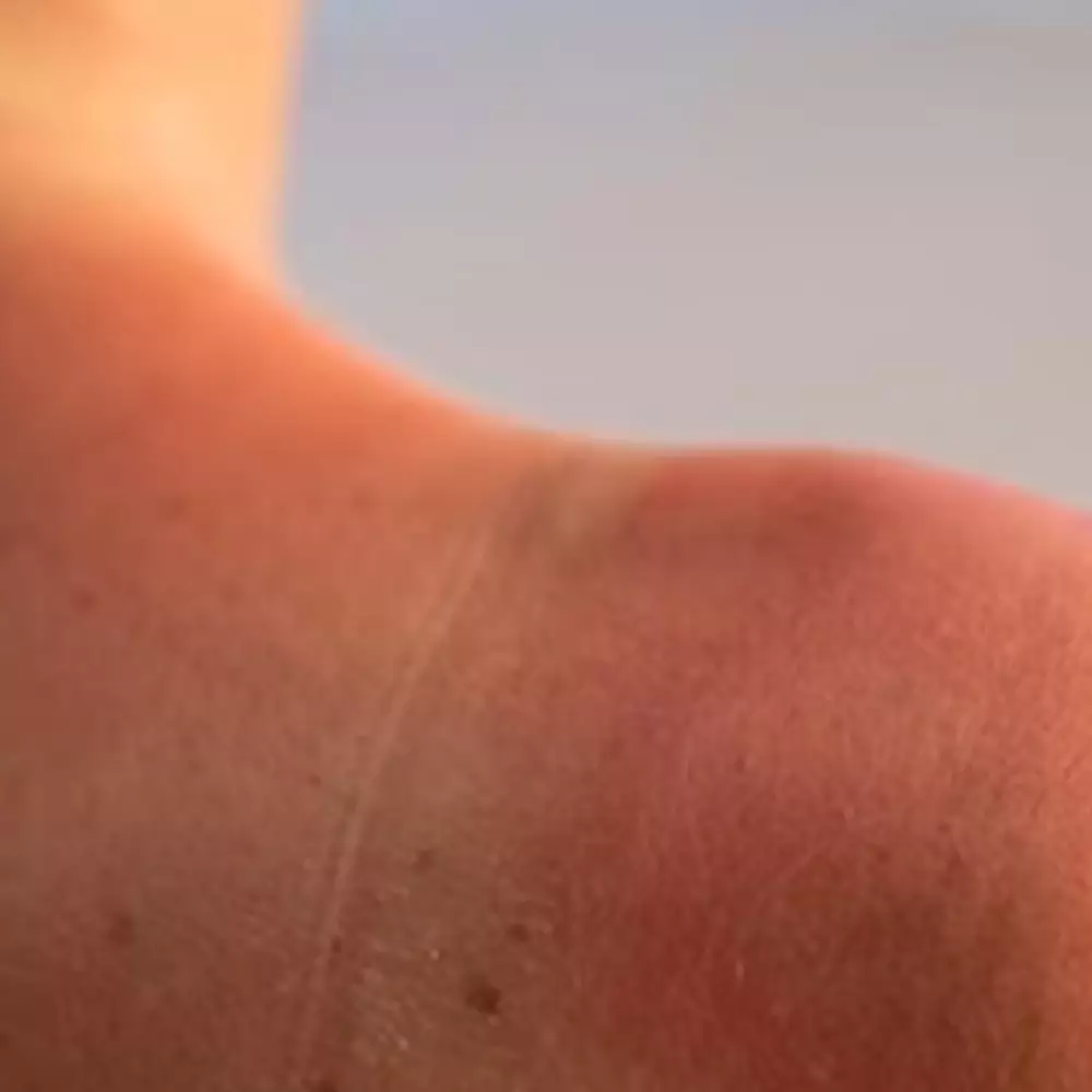 Tanpa bantuan obat, 9 bahan alami ini bisa atasi sunburn agar kulit mulus kembali