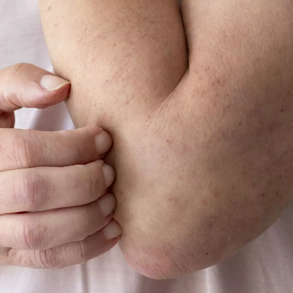 Trik hilangkan panu di tangan hanya pakai 1 bumbu dapur ini bikin kulit sehat dan bebas noda putih