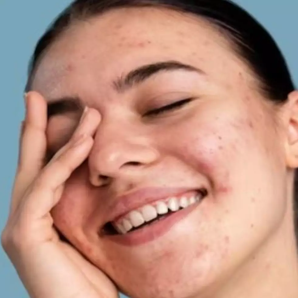 Cara mengatasi peradangan akibat jerawat pakai masker dari 1 jenis bahan pemanis, wajah auto mulus