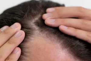 Cara menumbuhkan rambut pitak area dahi pakai 3 jenis minyak, bantu atasi rontok dan botak