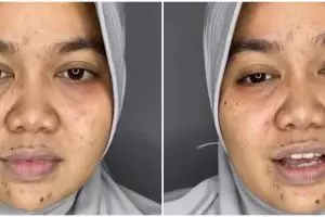 Wanita berjerawat ini automulus berkat makeup, transformasinya dandan soft glam jadi manglingi pol