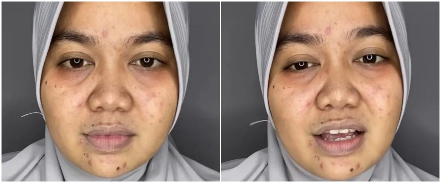 Wanita berjerawat ini automulus berkat makeup, transformasinya dandan soft glam jadi manglingi pol