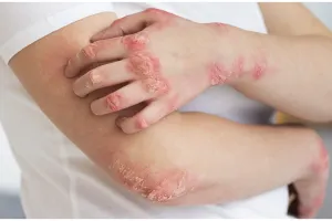 Cara hilangkan kudis di tangan hanya pakai 1 bahan sayuran ini bikin kulit sembuh total